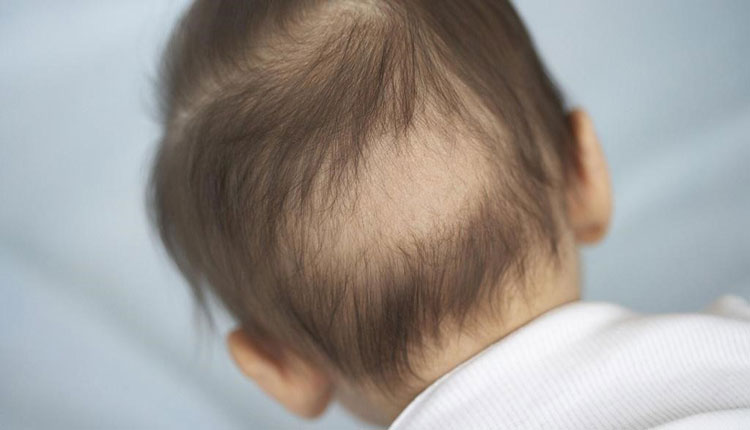 ریزش موی سر نوزادان