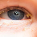 قی چشم نوزاد چشم آبی