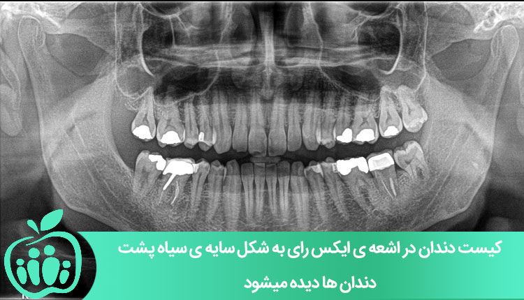 تشخیص کیست های دهان و دندان با اشعه ی ایکس رای