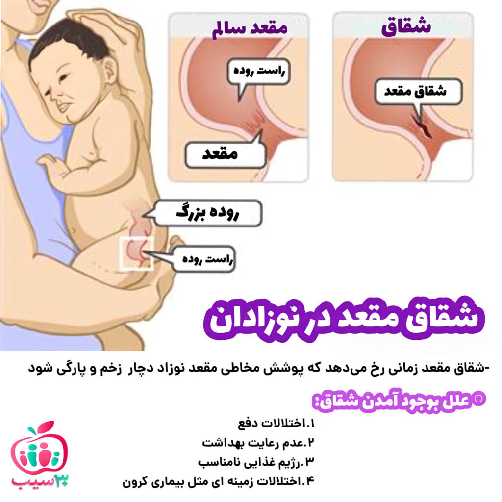 اینفوگرافی شقاق مقعد نوزادان
