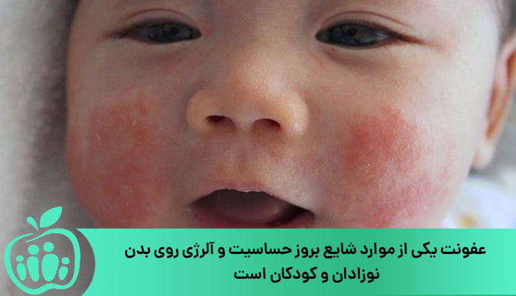 عفونت و بروز حساسیت پوستی در نوزادان