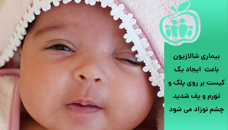 پف چشم نوزاد به علت بیماری شالازیون