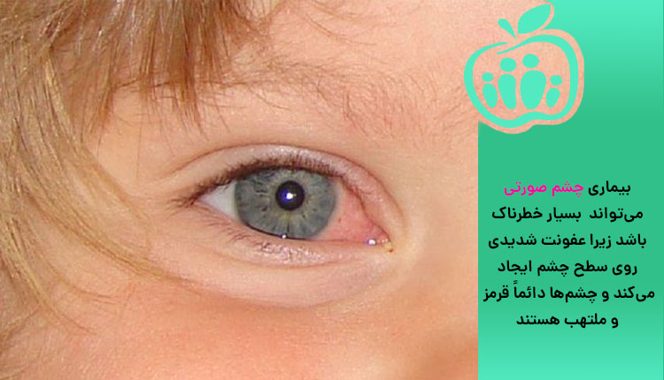 قی چشم و بیماری چشم صورتی