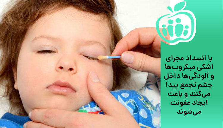 انسداد مجرای اشکی و ارتباط آن با عفونت چشم نوزاد