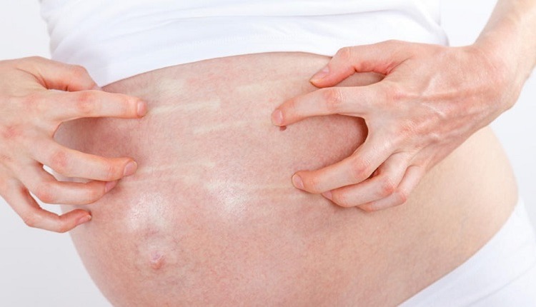 درمان خارش پوست در بارداری