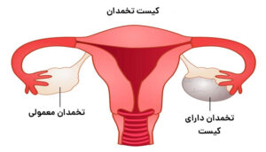 بارداری بعد از عمل کیست تخمدان