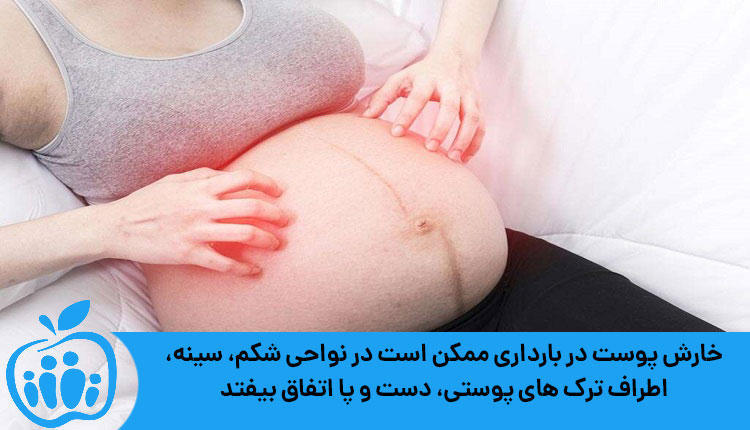 نواحی خارش پوست در بارداری